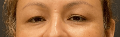 Eyelid Surgery Before & After Patient #10820