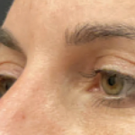 Eyelid Surgery Before & After Patient #10777