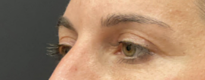 Eyelid Surgery Before & After Patient #10777