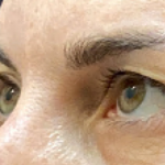 Eyelid Surgery Before & After Patient #10777