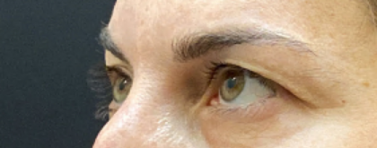 Eyelid Surgery Before & After Patient #10777