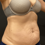 Tummy Tuck Before & After Patient #10877