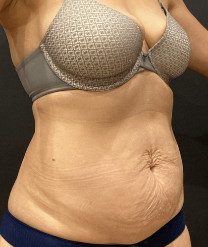 Tummy Tuck Before & After Patient #10877