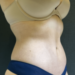 Tummy Tuck Before & After Patient #10877