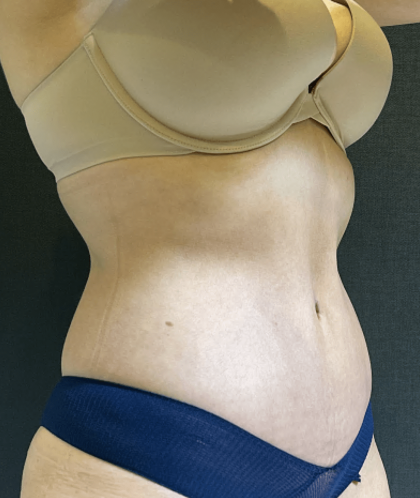 Tummy Tuck Before & After Patient #10877