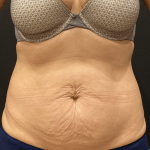 Tummy Tuck Before & After Patient #10877