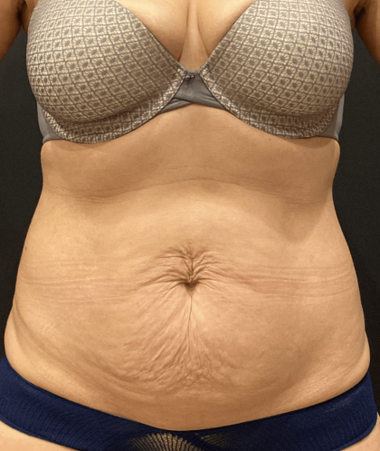 Tummy Tuck Before & After Patient #10877