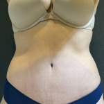 Tummy Tuck Before & After Patient #10877