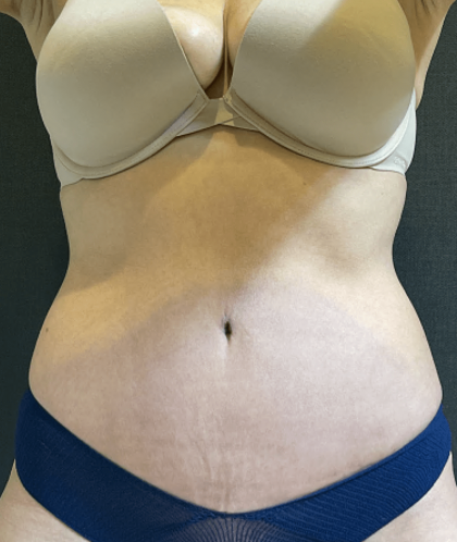 Tummy Tuck Before & After Patient #10877