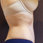 Tummy Tuck Before & After Patient #10877