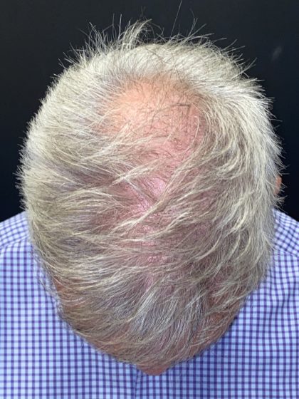 Hair Restoration with Neograft Before & After Patient #10946