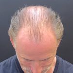 Hair Restoration with Neograft Before & After Patient #10949