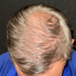 Hair Restoration with Neograft Before & After Patient #10946