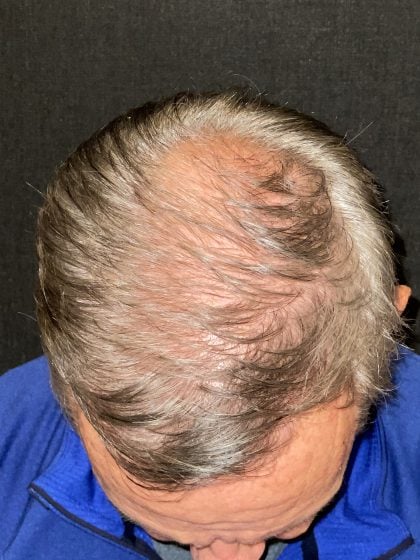 Hair Restoration with Neograft Before & After Patient #10946