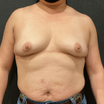 Breast Augmentation Before & After Patient #11004