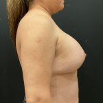 Breast Augmentation Before & After Patient #11004