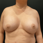 Breast Augmentation Before & After Patient #11004