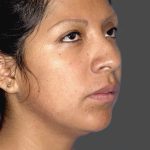 Rhinoplasty Before & After Patient #11130