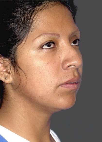 Rhinoplasty Before & After Patient #11130