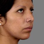 Rhinoplasty Before & After Patient #11130