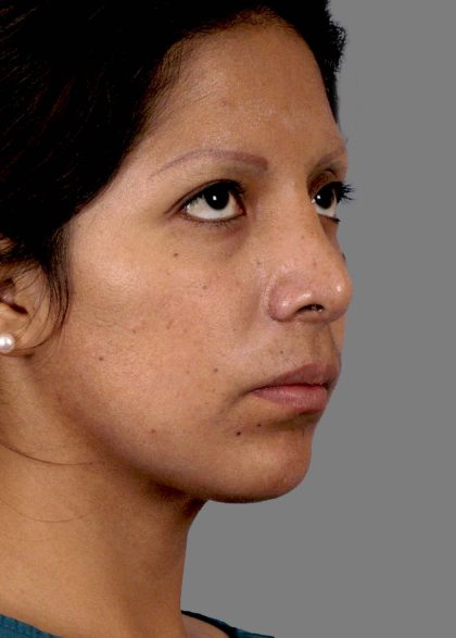 Rhinoplasty Before & After Patient #11130