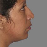 Rhinoplasty Before & After Patient #11130