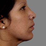 Rhinoplasty Before & After Patient #11130