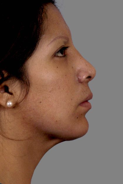 Rhinoplasty Before & After Patient #11130