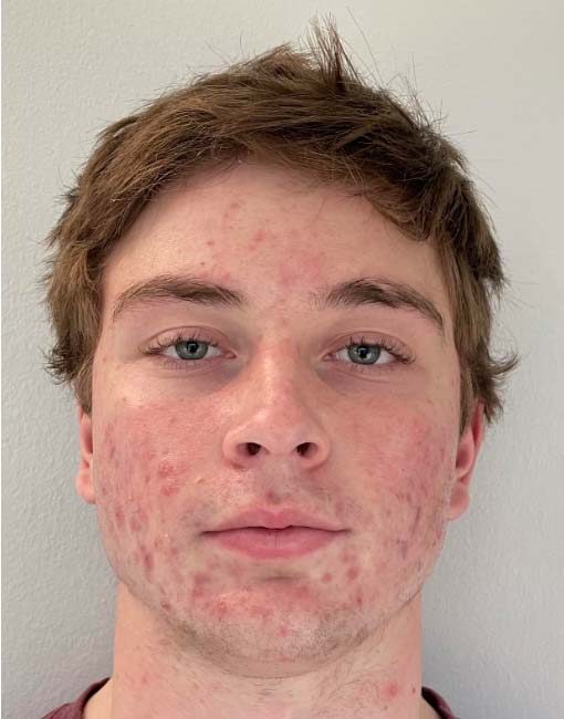 Laser Acne Protocol Before & After Patient #11199