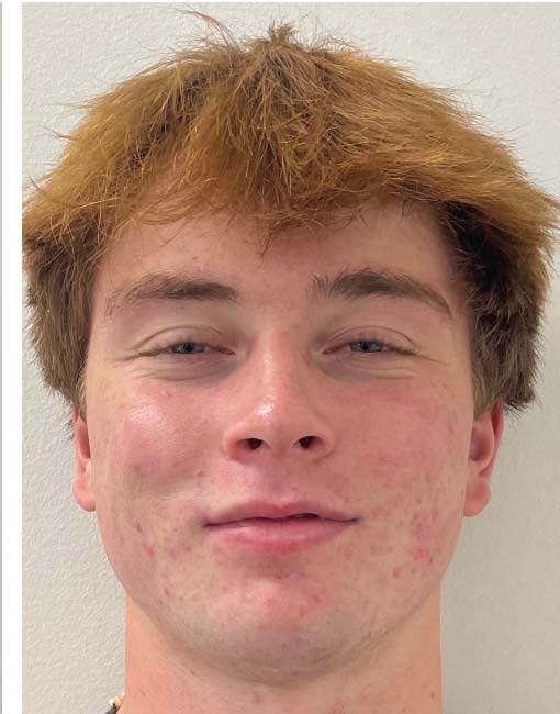 Laser Acne Protocol Before & After Patient #11199