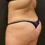 Fat Transfer to Butt Before & After Patient #11405