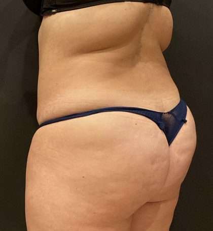 Fat Transfer to Butt Before & After Patient #11405