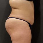 Fat Transfer to Butt Before & After Patient #11405