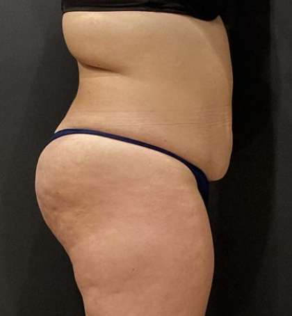 Fat Transfer to Butt Before & After Patient #11405