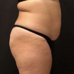 Fat Transfer to Butt Before & After Patient #11405