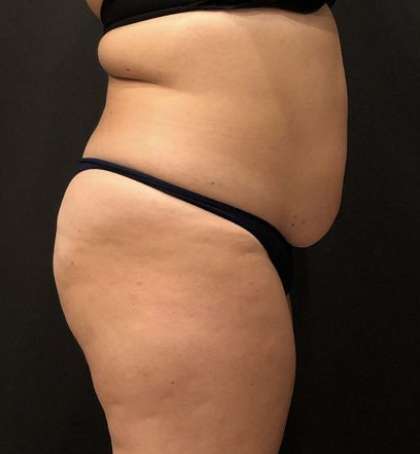 Fat Transfer to Butt Before & After Patient #11405