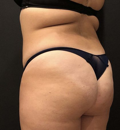 Fat Transfer to Butt Before & After Patient #11405
