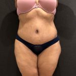 Liposuction Before & After Patient #11526