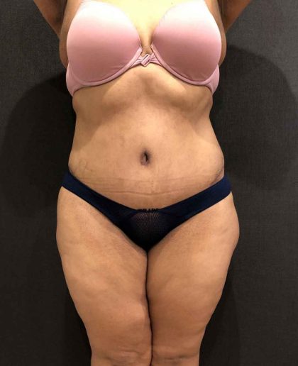 Liposuction Before & After Patient #11526