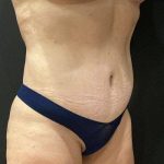 Tummy Tuck Before & After Patient #11479