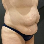 Tummy Tuck Before & After Patient #11479