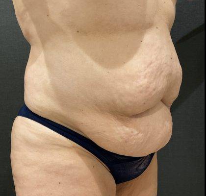 Tummy Tuck Before & After Patient #11479