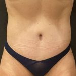 Tummy Tuck Before & After Patient #11479