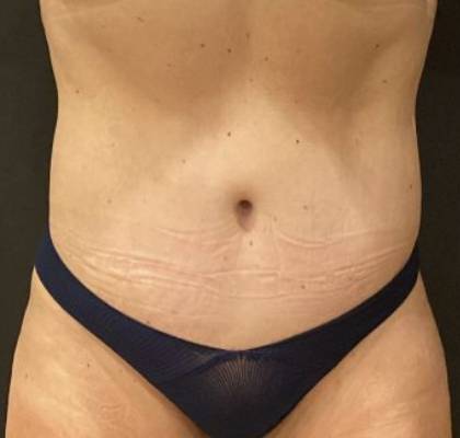 Tummy Tuck Before & After Patient #11479