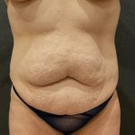 Tummy Tuck Before & After Patient #11479