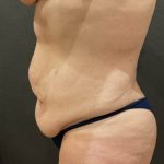 Tummy Tuck Before & After Patient #11479