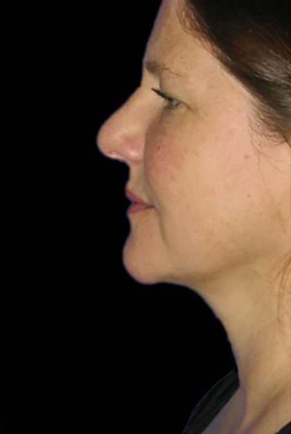 Necklift Before & After Patient #11533