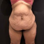 Liposuction Before & After Patient #11526