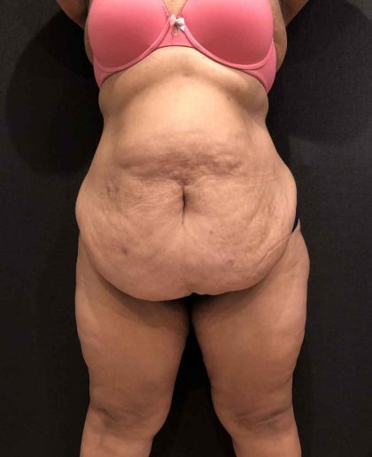 Liposuction Before & After Patient #11526