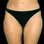 Liposuction Before & After Patient #11543